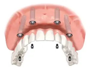 dental implant marketing