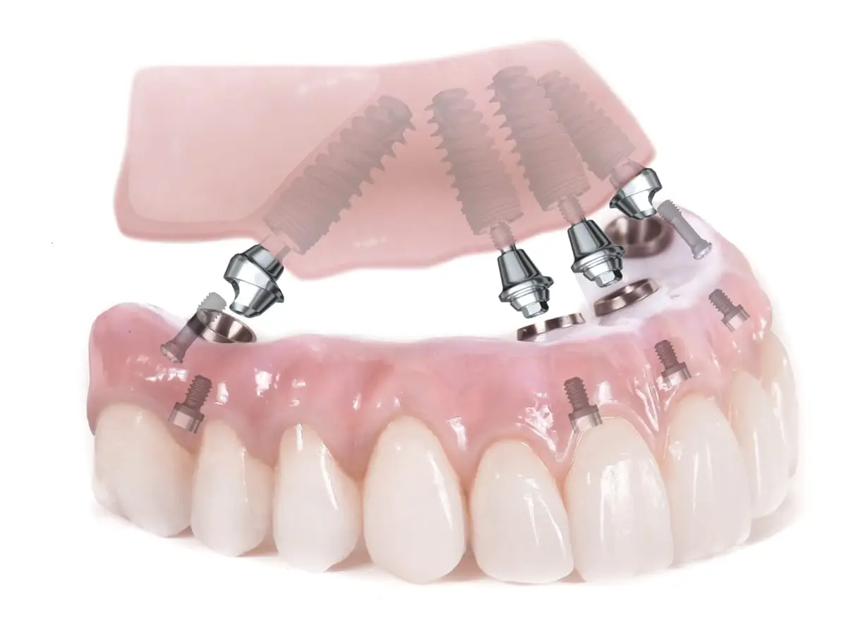 All-on-4 Dental Implant Marketing