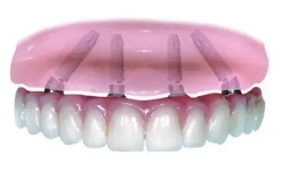dental implant marketing