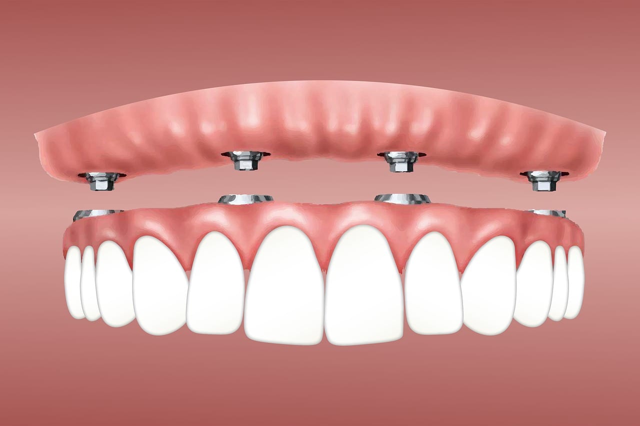 professional dental implant sales